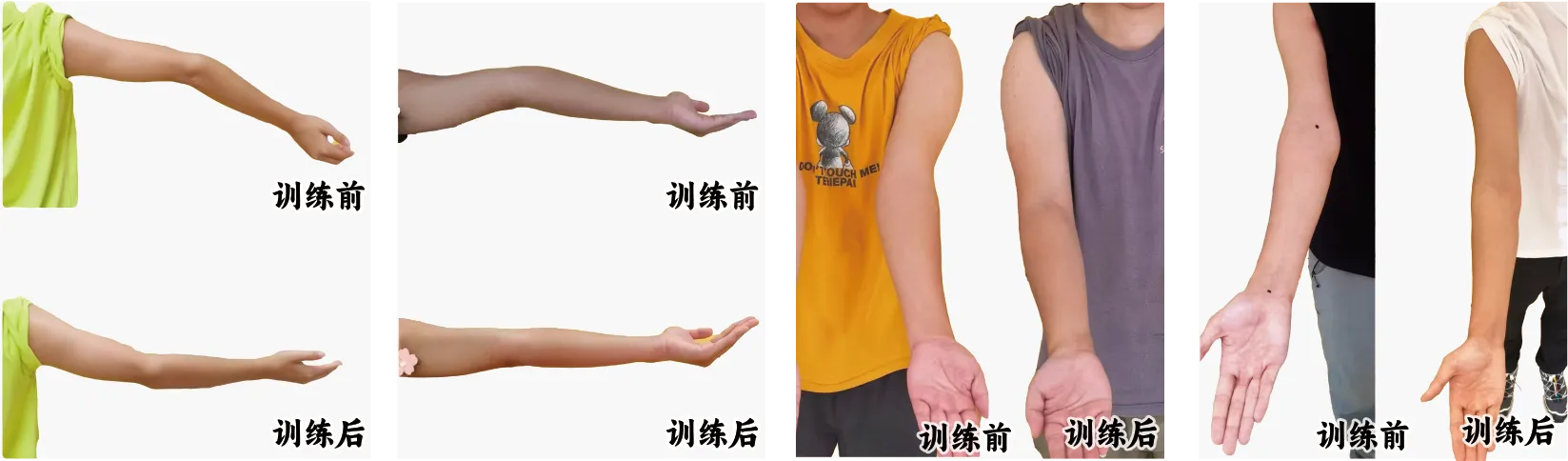 肘过伸矫正案例